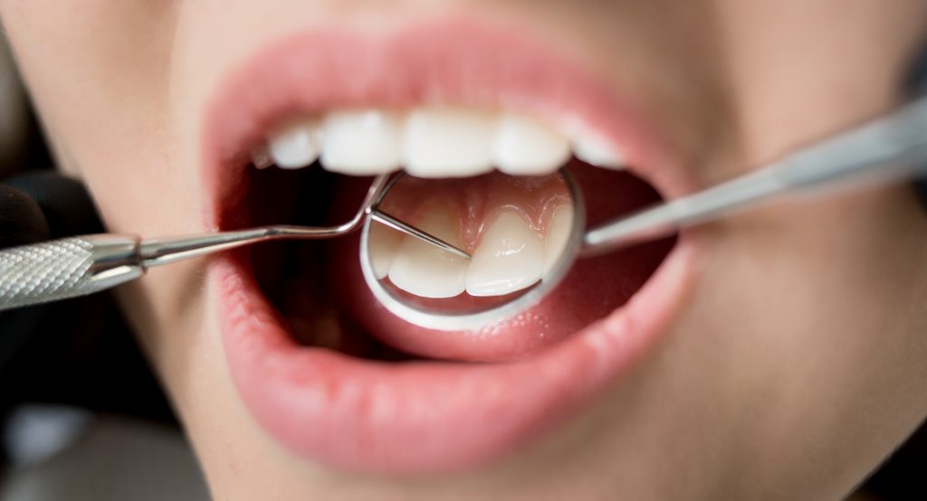 Why-Would-You-Require-a-Dental-Filling-scaled